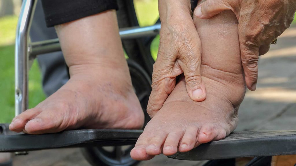 geschwollene Beine und Füße können auf Krankheiten hinweisen