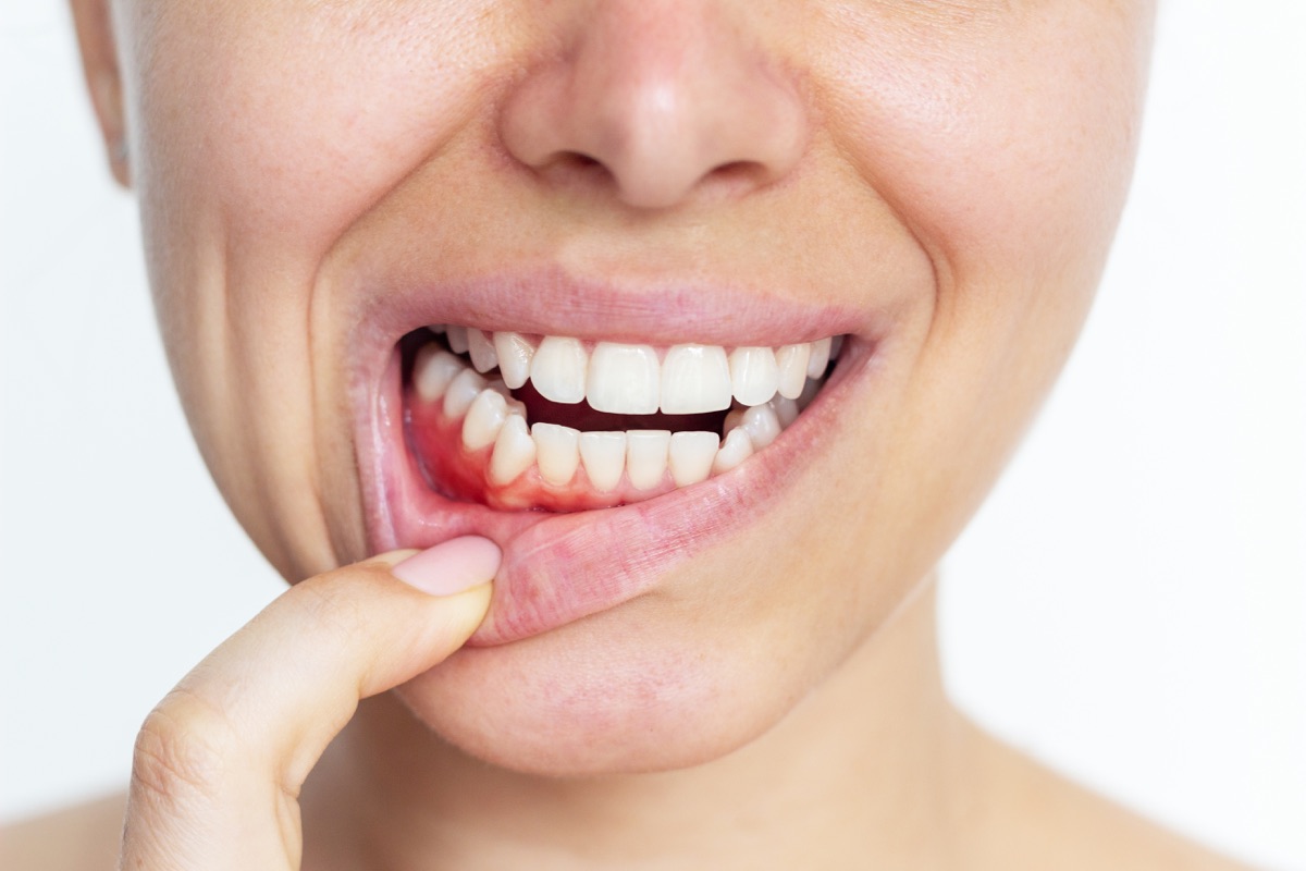 Junge Frau zeigt entzündetes, gerötetes Zahnfleisch als Anzeichen für Gingivitis